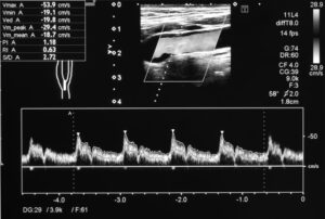 carotid ultrasound
