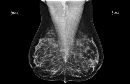The results of a 3D mammogram.