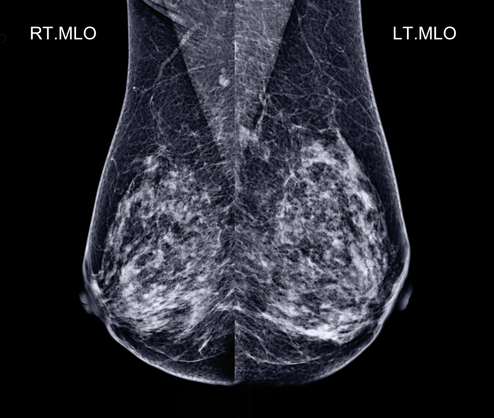 xray of two breast.