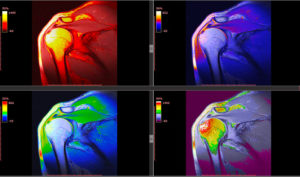Radiology Imaging of Human Musculoskeletal System- Shoulder MRI 