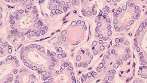 Common Questions About Thyroid FNA Analysis