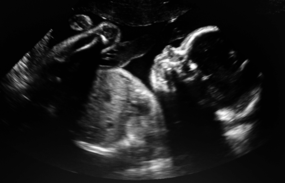 ultrasound of a baby.