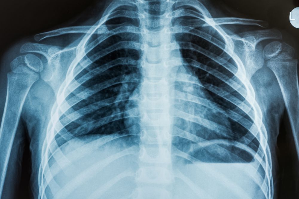 x ray of the chest.