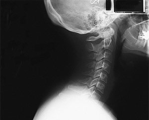 X-ray of the neck and raw.