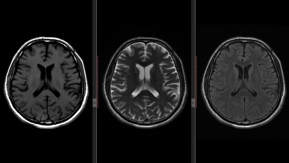Brain MRI Scan (Magnetic Resonance) High Resolution