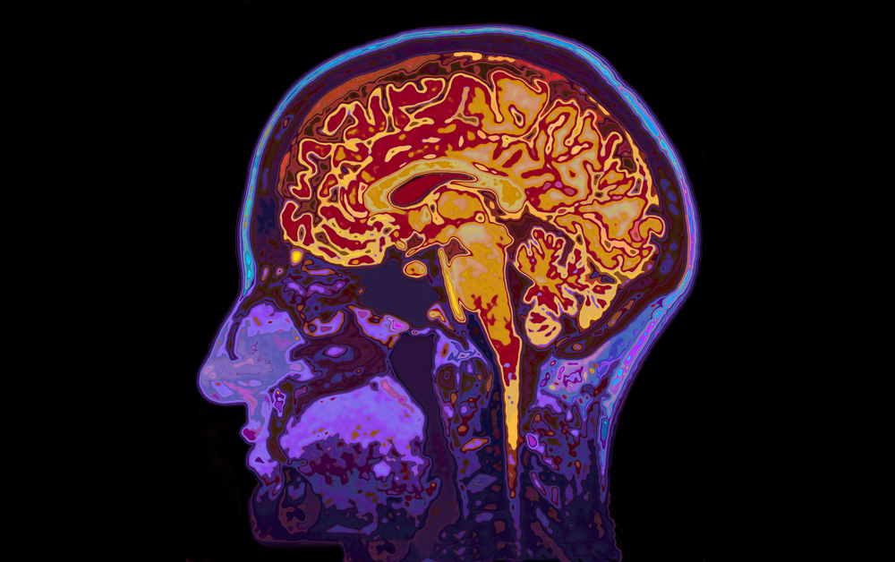 MRI Image Of Head Showing Brain