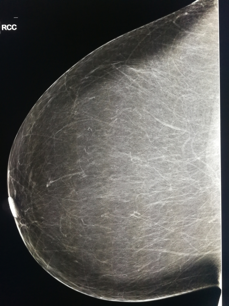 Image of a breast density scan.